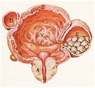 Adénome d la prostate (A) qui comprime le canal de l'urètre et empêche l'écoulement correct des urines de la vessie (V). A la longue la vessie devient trabéculée, des diverticules (D) et des calculs peuvent se développer (C) favorisant la survenue d'infection ou d'insuffisance rénale  