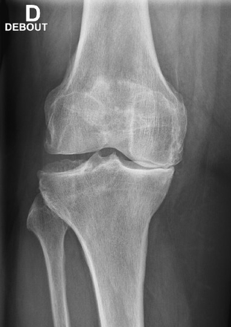 Résultat de recherche d'images pour "arthrose du genou"