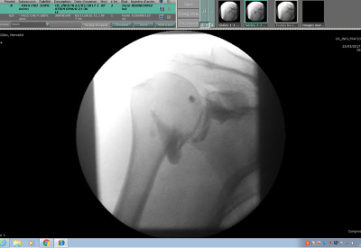 Scopie %c3%a9paule reduit